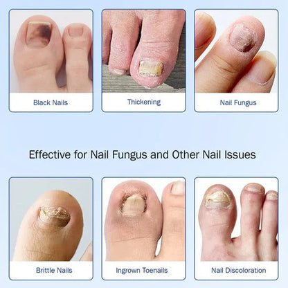 [Official Shop] Clinclii Fungus Nail Patches-Suitable for Solving Fungal Nails